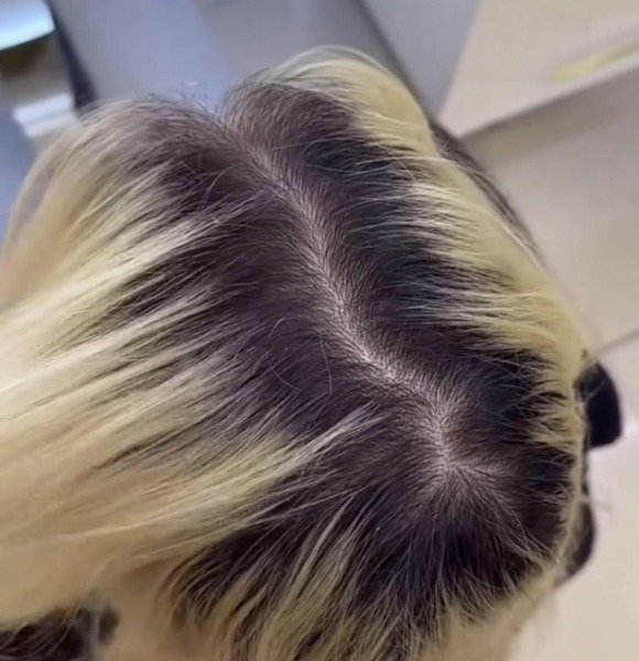 Decoloración con peróxido de 10 volúmenes